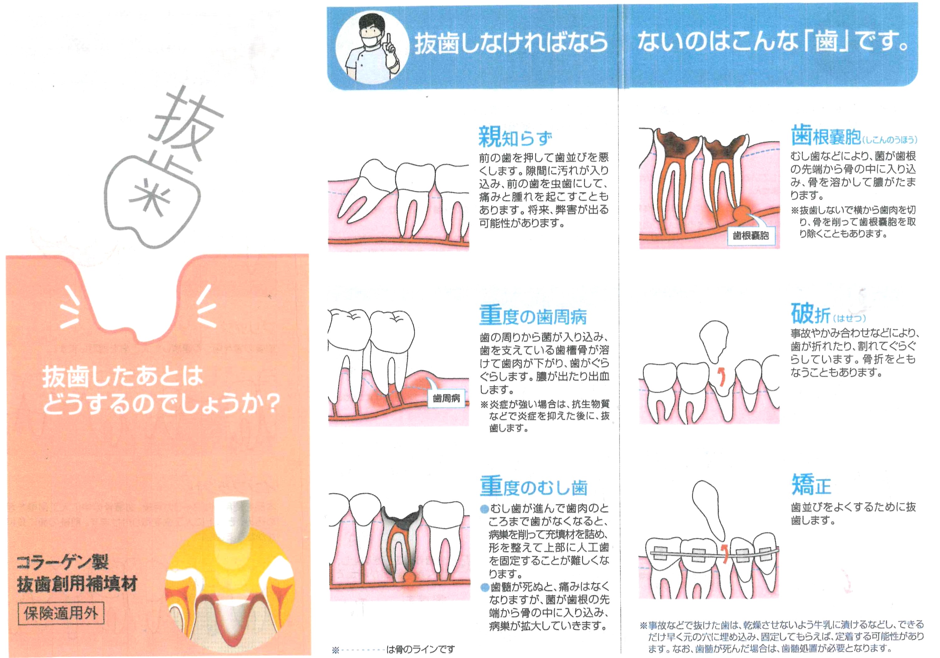 テルプラグパンフレット